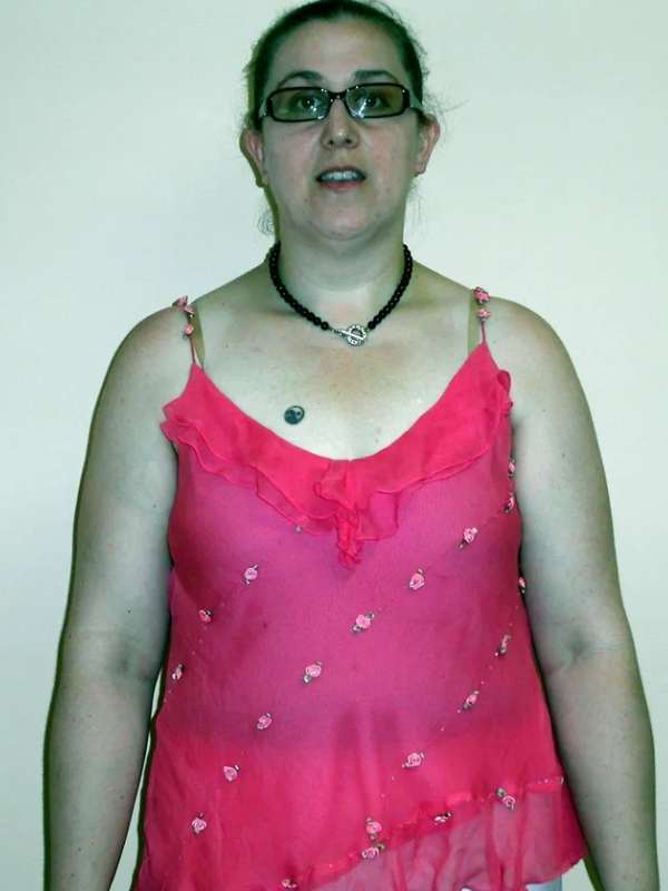 Amy’s Success Story at The Institute for Weight Management & Wellness in Hackensack, NJ