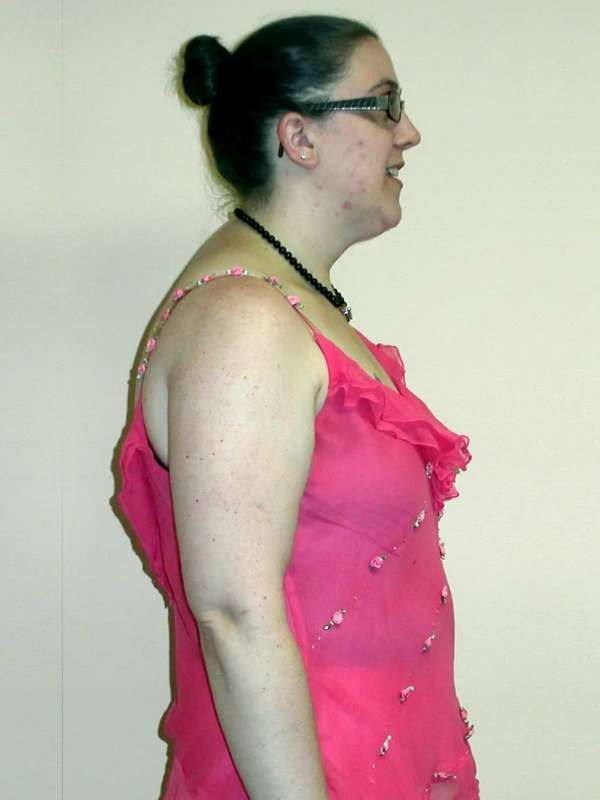 Amy’s Success Story at The Institute for Weight Management & Wellness in Hackensack, NJ