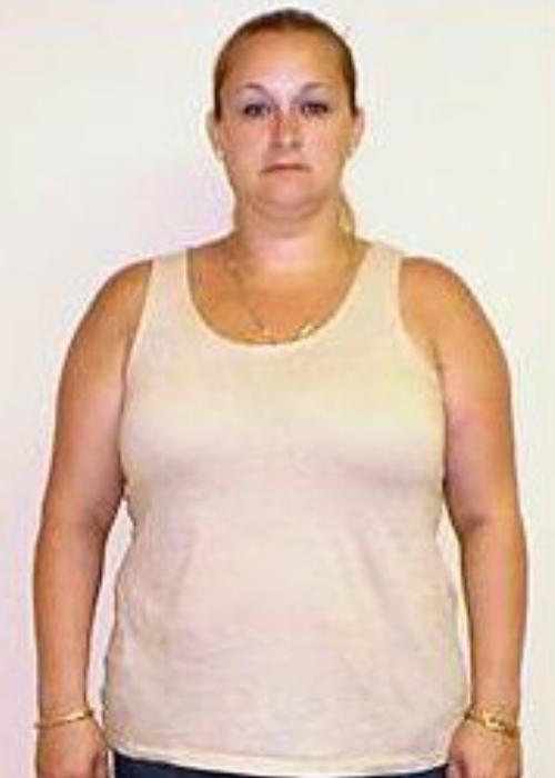 Angela’s Success Story at The Institute for Weight Management & Wellness in Hackensack, NJ